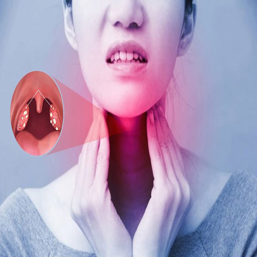   Bệnh amidan mãn tính có xu hướng kéo dài và rất dễ tái phát. Điều này làm ảnh hưởng trực tiếp với sức khỏe của người bệnh. Bên cạnh đó, với sự diễn biến phức tạp và lây lan nhanh chóng của dịch bệnh Covid 19 có thể gây ảnh hưởng xấu cho người bệnh amidan mãn tính. Vậy người mắc bệnh amidan mãn tính cần làm gì để bảo vệ sức khỏe của mình trong mùa dịch Covid?
