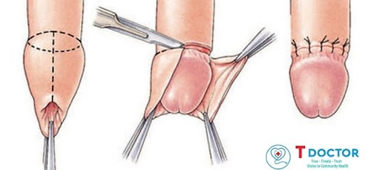 Hẹp bao quy đầu là một tình trạng phổ biến. Tuy nhiên, khi đến độ tuổi dậy thì mà bao quy đầu vẫn chữa tụt xuống thì cần phải được can thiệp để tránh các rủi ro không đáng có