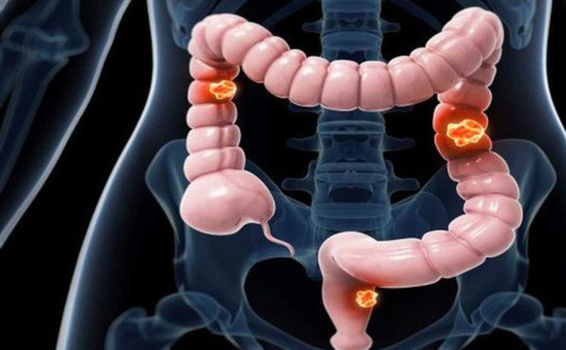 Toàn bộ kiến thức cần biết về ung thư đại trực tràng