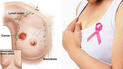 Ung thư vú: 6 Dấu hiệu báo động sớm 